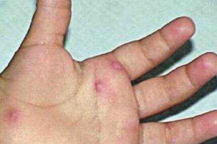 宝宝手足口病初期症状 “一摸二看”早辨别