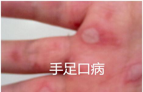 手足口病是不是水痘 3点准确区分手足口与水痘？
