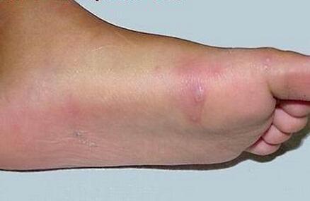 手足口病疱疹怎么治疗 怎么根到病除，不结疤？