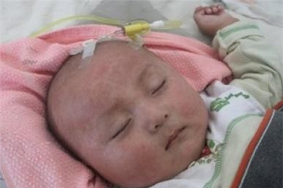 婴儿出风疹能吹风吗？