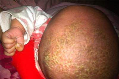 婴儿乳痂是什么意思