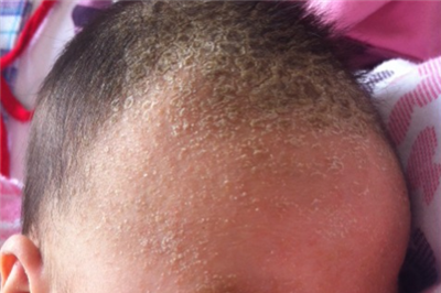 婴儿乳痂是什么颜色的？