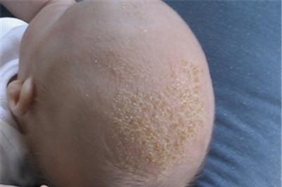 乳痂对宝宝的危害有哪些？