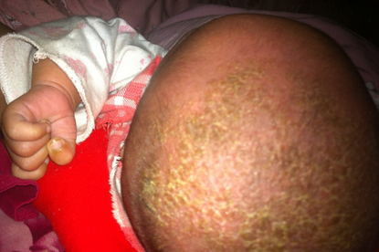 婴儿乳痂洗掉了还会长怎么预防？