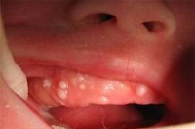 婴儿马牙是什么？