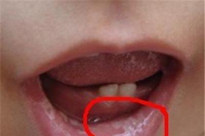 宝宝马牙与鹅口疮的区别