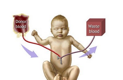 新生儿溶血病换血疗法是什么
