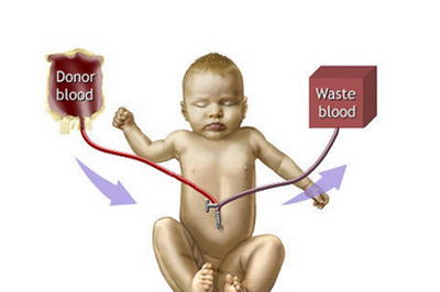 新生儿溶血病换血疗法是什么