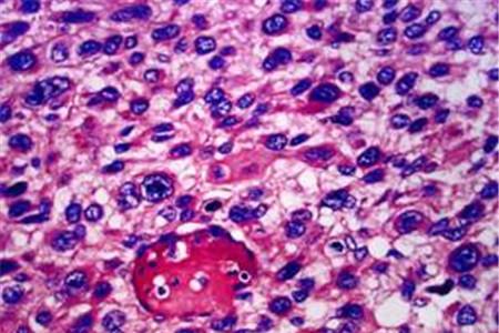 葡萄胎可以治好吗