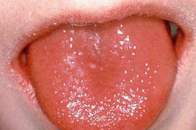 小孩草莓舌是怎么回事？