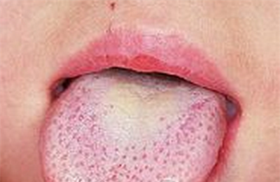 孩子草莓舌会有什么病？