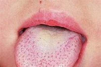 小孩草莓舌多久能好？