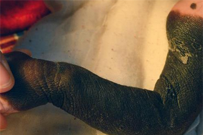 兽皮痣怎么治疗？