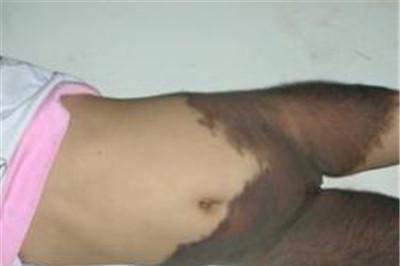 兽皮痣会遗传吗？