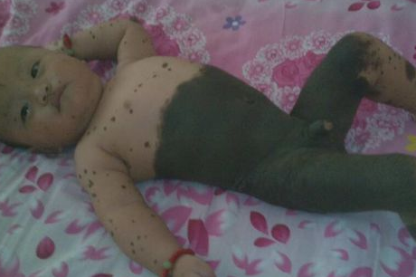 兽皮痣有啥危害？