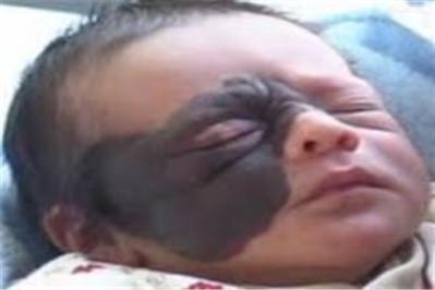 兽皮痣可以根治吗？