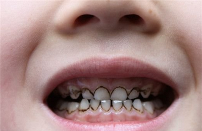 小儿龋齿分哪几种类型？