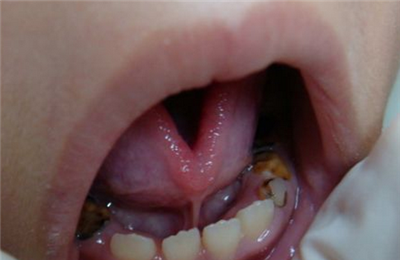 儿童龋齿发病率是多少？