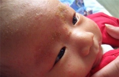 新生儿湿疹是怎么引起的？