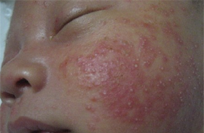 新生儿湿疹和痤疮的区别