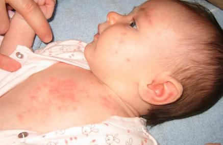 新生儿湿疹和痱子的区别
