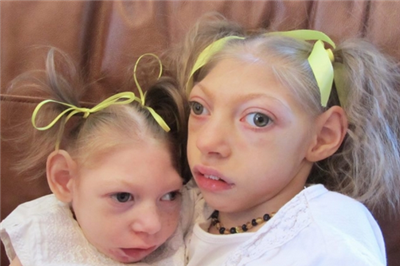 新生儿小头症症状