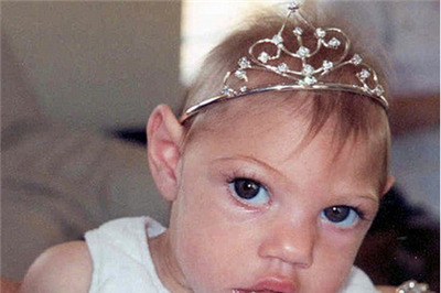 婴儿小头症多大能确认？