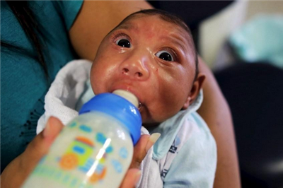 如何判断小头症？