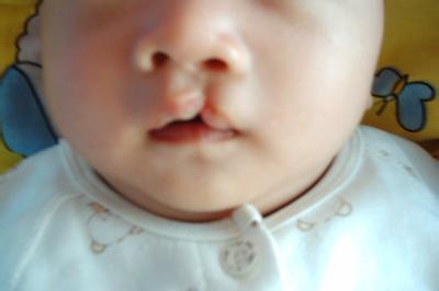 为什么姐姐二胎生了个兔唇宝宝