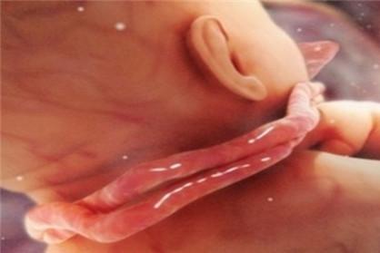 脐带绕颈一周怎么办