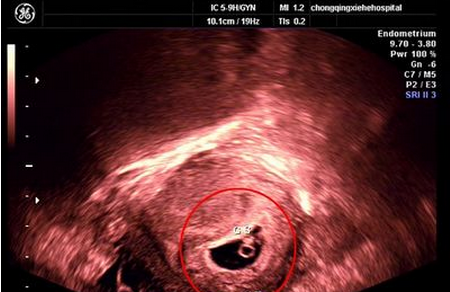 怀孕4周能看见孕囊吗