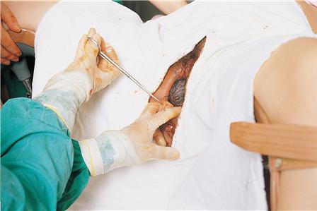 顺产侧切是什么意思