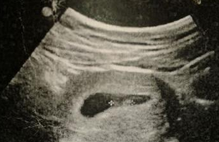 怀孕5周能看到孕囊吗