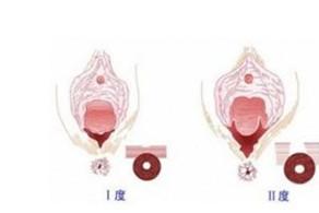 顺产侧切跟撕裂的区别有哪些
