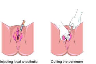 顺产侧切是切哪里
