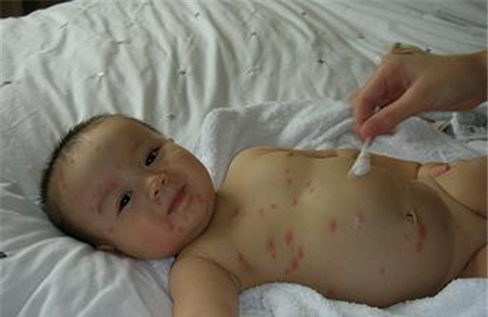 宝宝出水痘如何治疗？