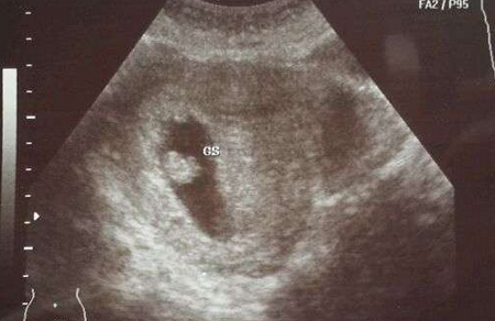 怀孕6周可以看见胎心胎芽吗