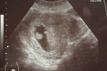 怀孕6周可以看见胎心胎芽吗