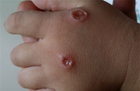 宝宝出水痘会留疤吗？