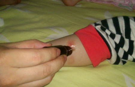 蚊虫叮咬如何止痒