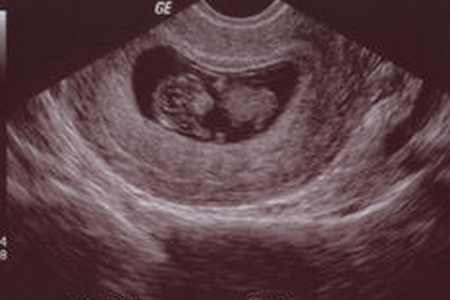 怀孕7周没有胎心正常吗