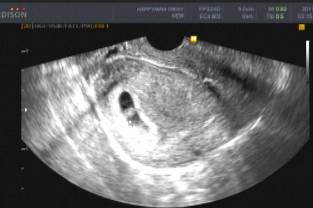 怀孕7周妊娠囊有多大