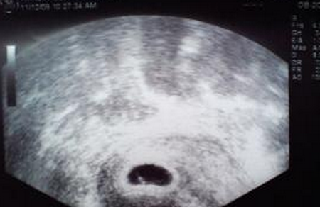 怀孕8周B超显示6周的胎停了吗