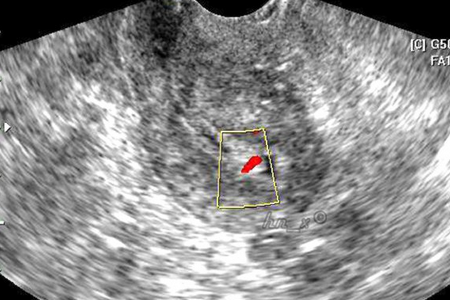 怀孕8周宫腔积液怎么办