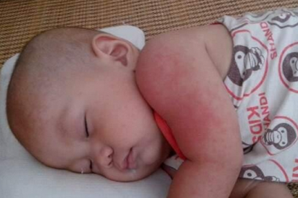 宝宝长痱子擦什么好的最快