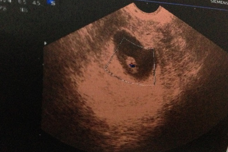 怀孕8周没有胎心胎芽正常吗