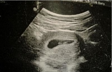 怀孕8周妊娠囊多大正常