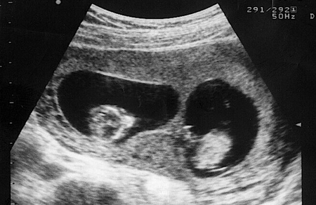 怀孕8周能查出双胞胎吗