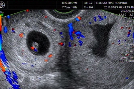 怀孕9周宫腔内有积液怎么办