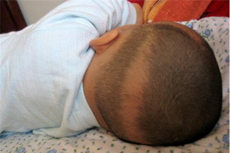 枕秃什么时候好